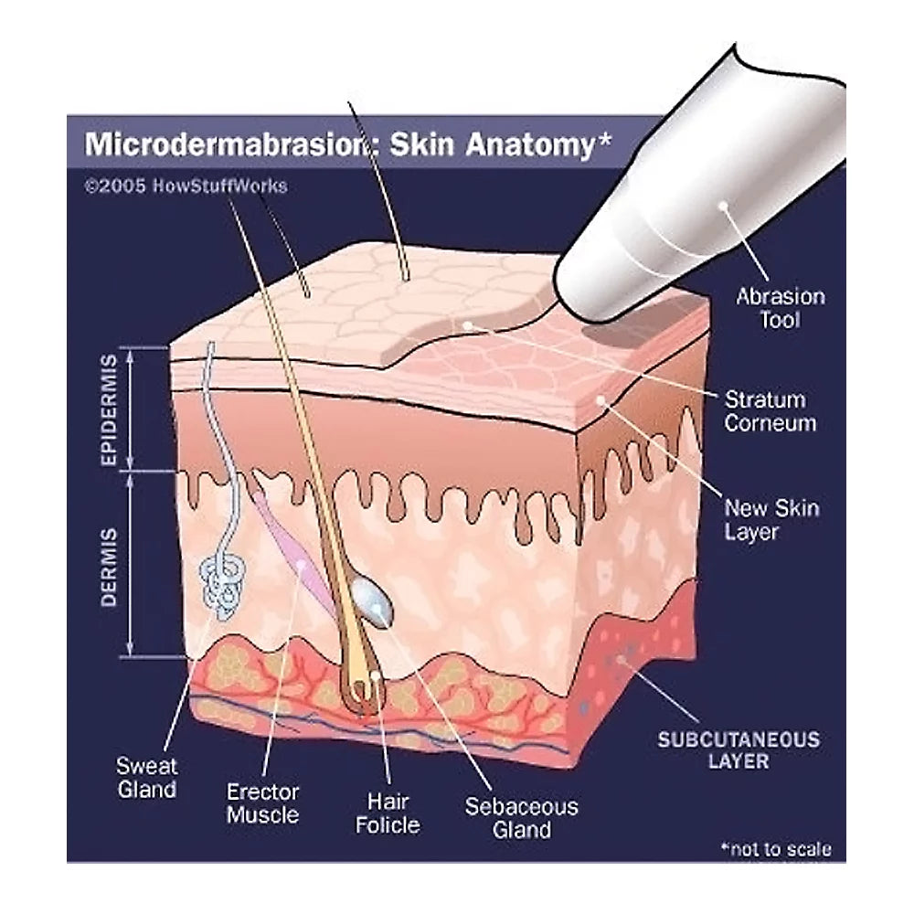 NeedCrystals Microdermabrasion Crystals, All-Natural Face Exfoliator, 4 lb T91042